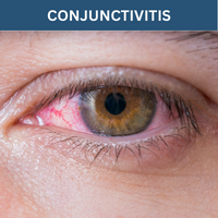 Conjunctivitis - Self Care